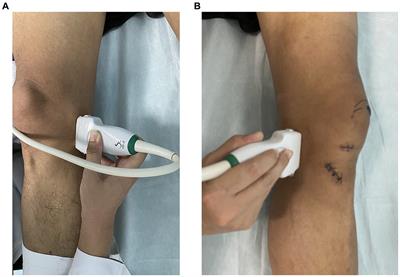 Analysis of the main indicators and risk factors of ultrasonic shear wave elastography for the diagnosis of osteoarthritis among adults